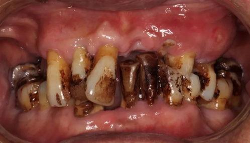 成人掉大牙还能长吗视频,还能否重获新生？