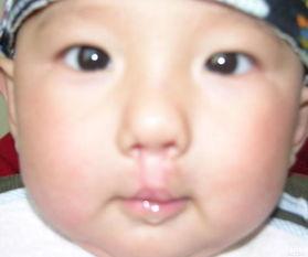 成人唇裂鼻子修复视频,成人唇裂与鼻修复手术全程揭秘