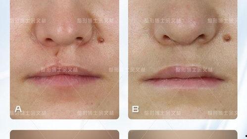 成人唇裂鼻子修复视频,成人唇裂与鼻修复手术全程揭秘