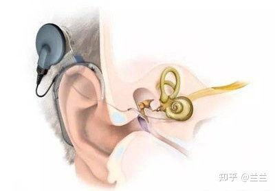 成人耳蜗更换视频大全,视频大全深度解析