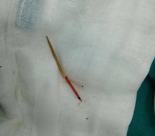 成人正畸牙签怎么刷视频