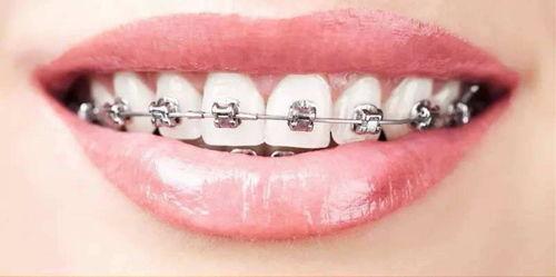 成人正畸牙签怎么刷视频