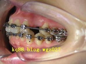 成人正畸牙签怎么刷视频